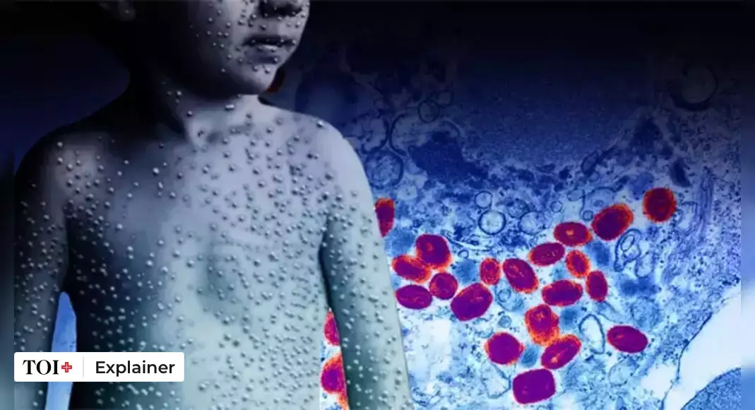Did William Heberden Distinguish Chickenpox From Smallpox in 1767?