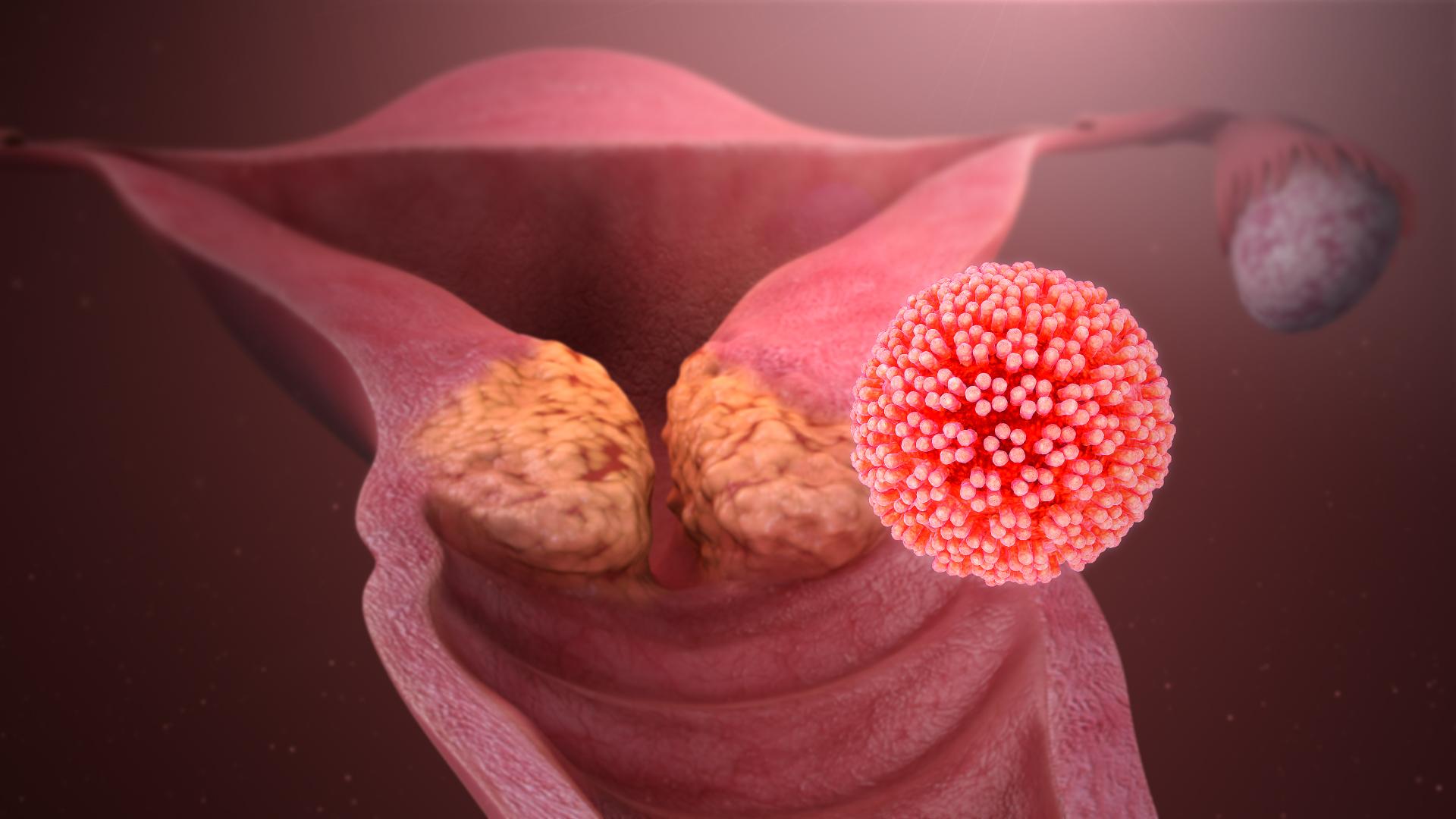 Does HPV Cause Cervical Cancer?